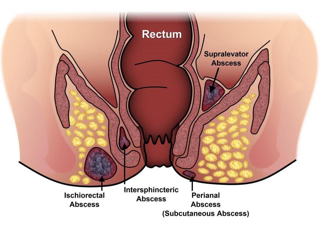 Περιεδρικό απόστημα πρωκτού