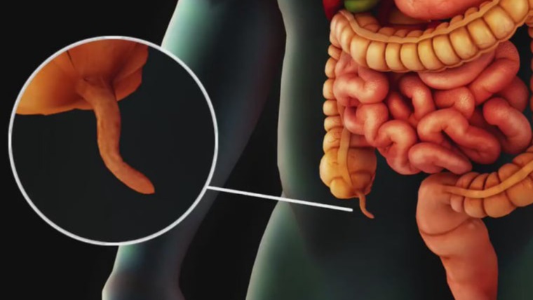 Σκωληκοειδίτιδα