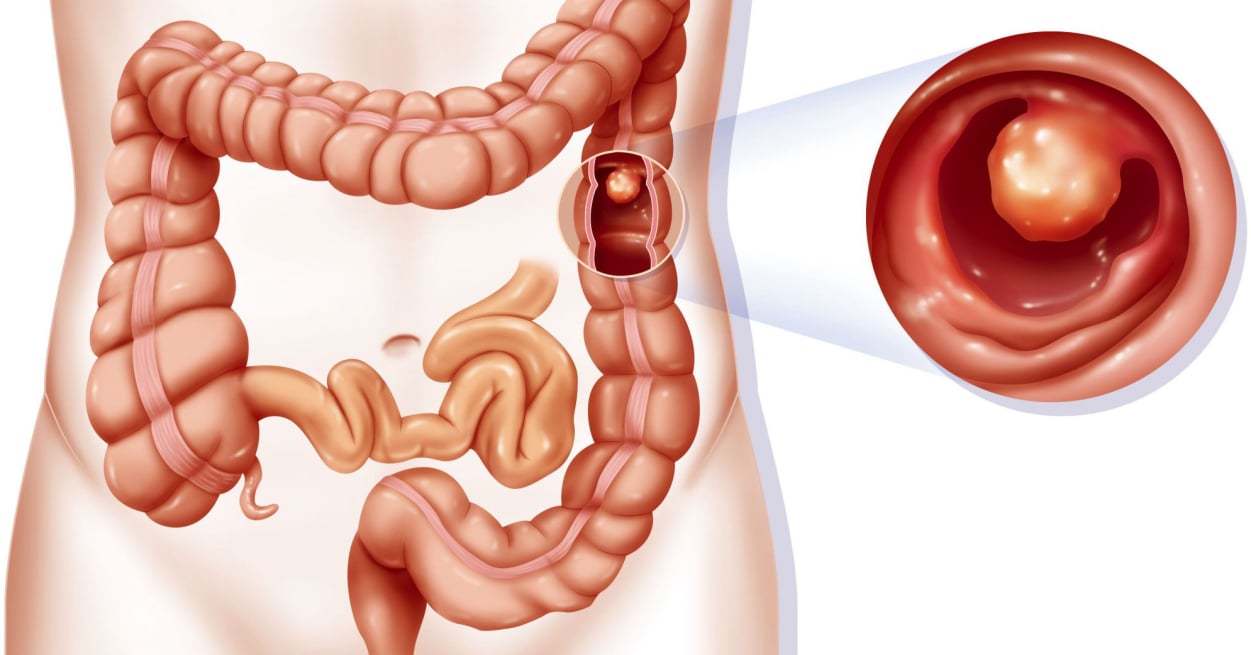 Καρκίνος παχέος εντέρου