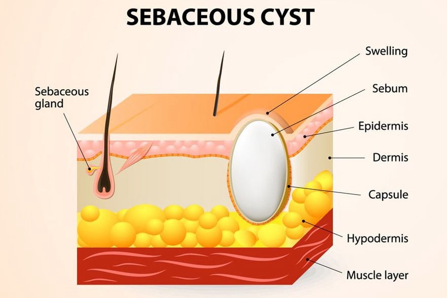 Σμηγματογόνος κύστη