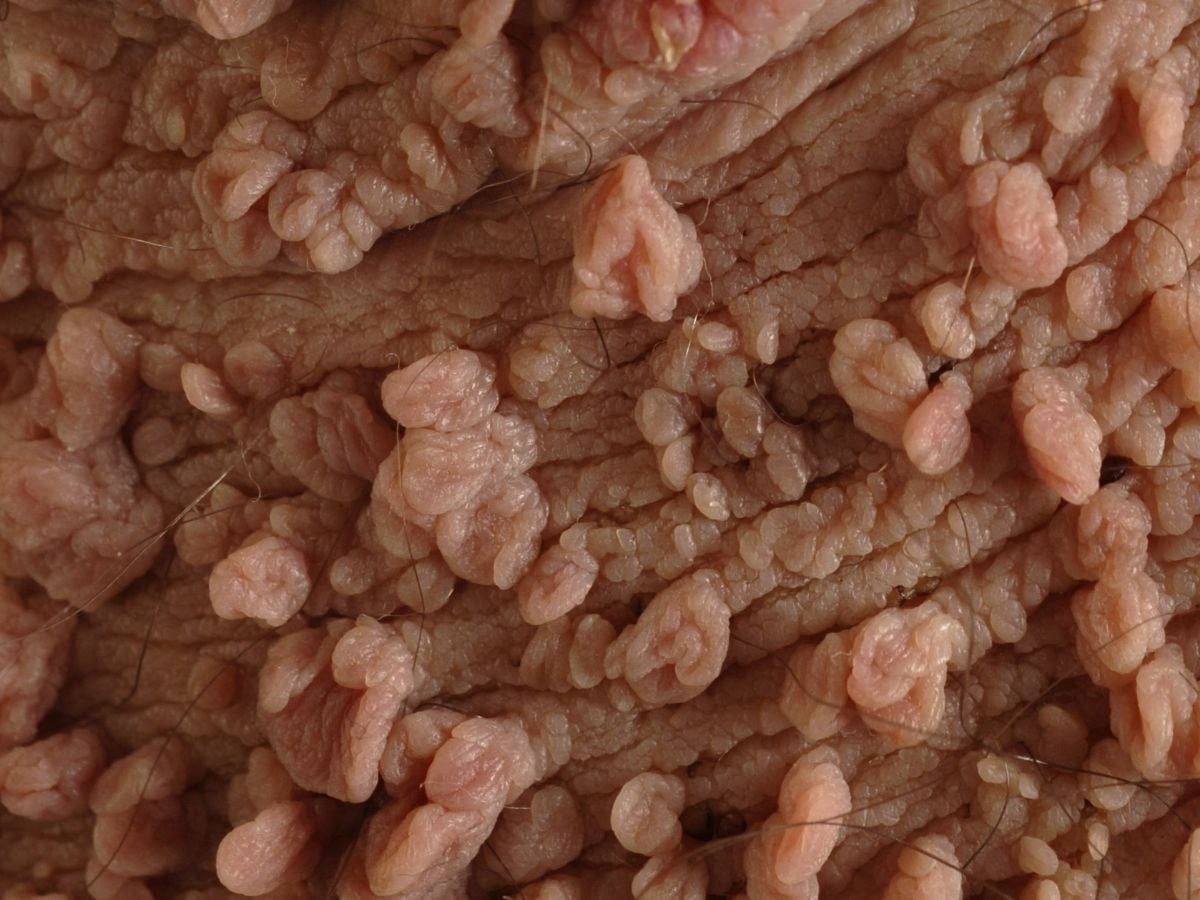 Ινομυώματα