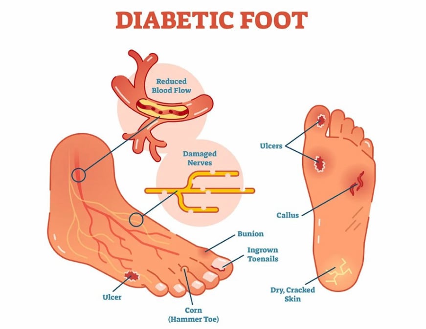 Διαβητικό πόδι