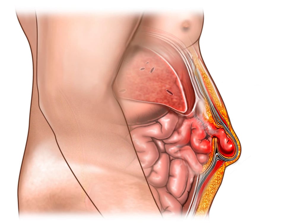Ομφαλοκήλη
