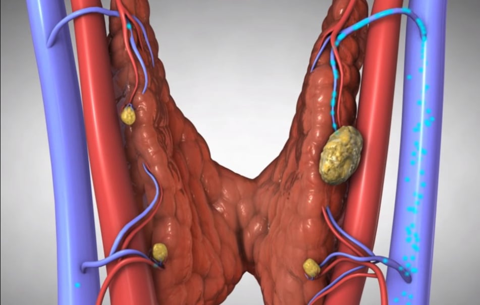 Υπερπαραθυρεοειδισμός