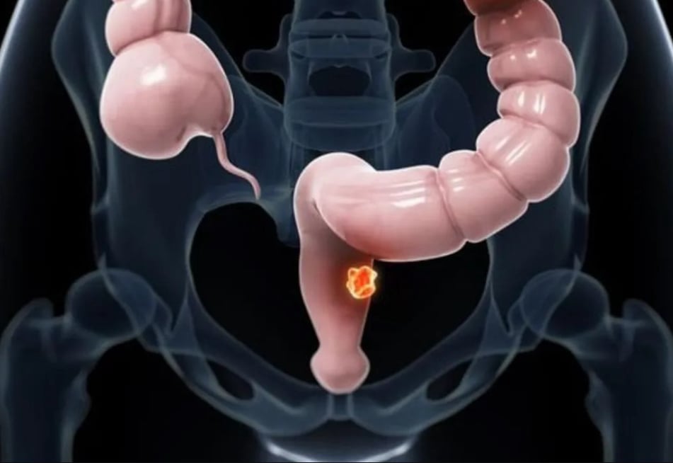 Καρκίνος ορθού