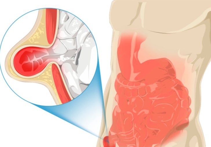 Κήλη αθλητών