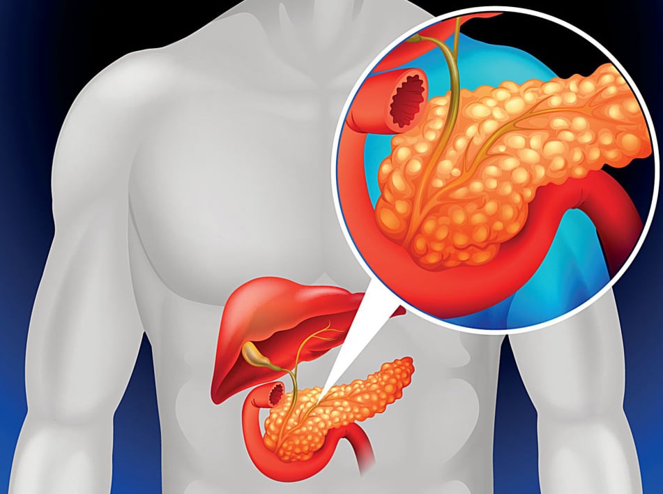 Οξεία παγκρεατίτιδα
