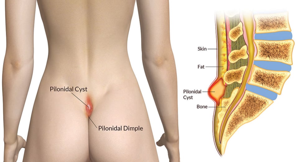 Κύστη κόκκυγος