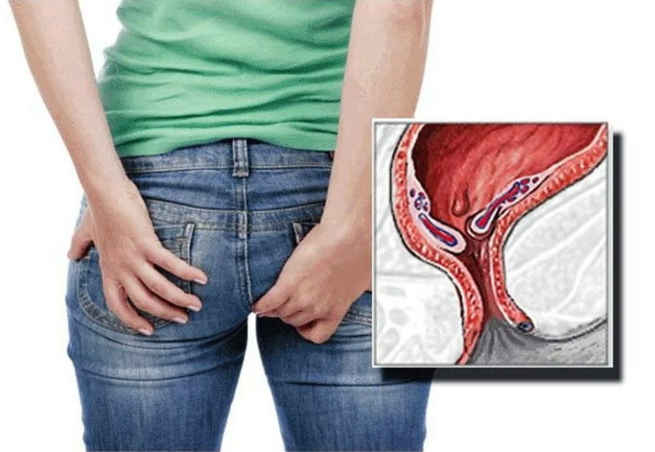 Παθήσεις του πρωκτού (αιμορροΐδες, ραγάδες του πρωκτού, συρίγγια, περιεδρικά αποστήματα)