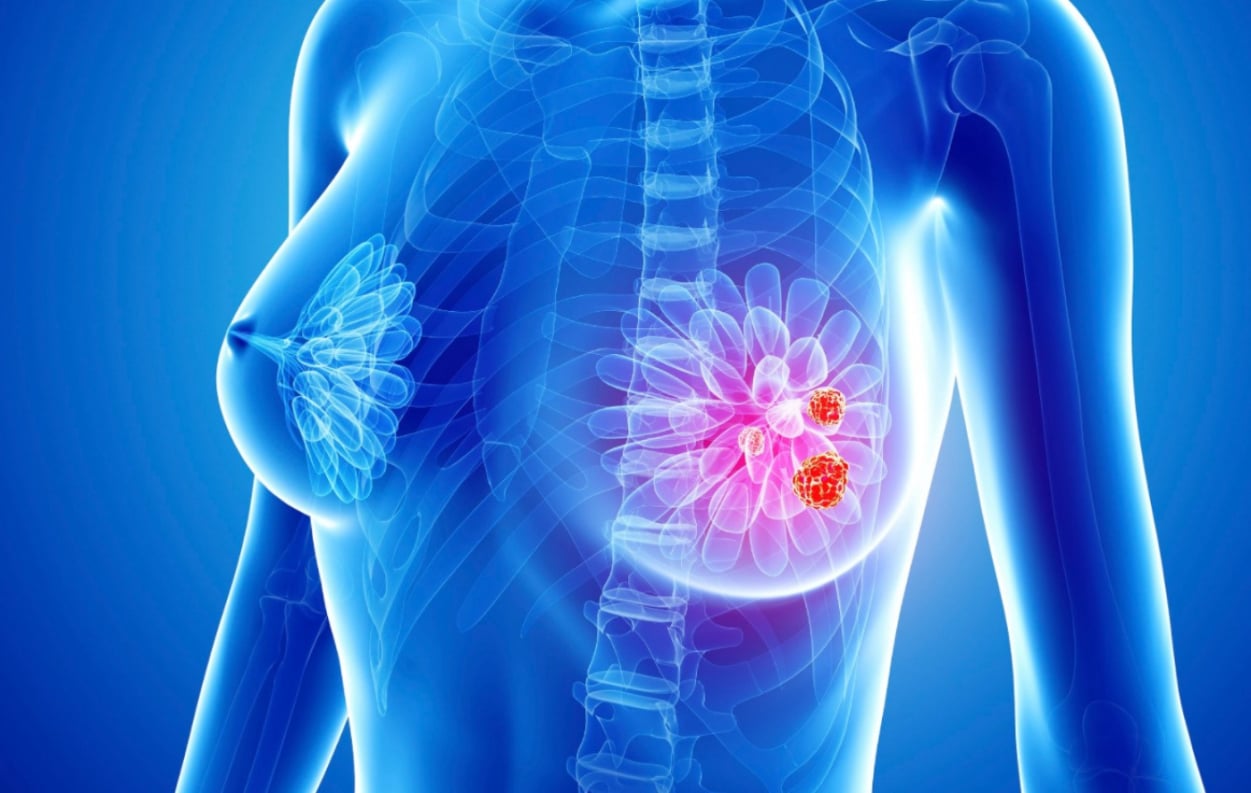 Καρκίνος του μαστού