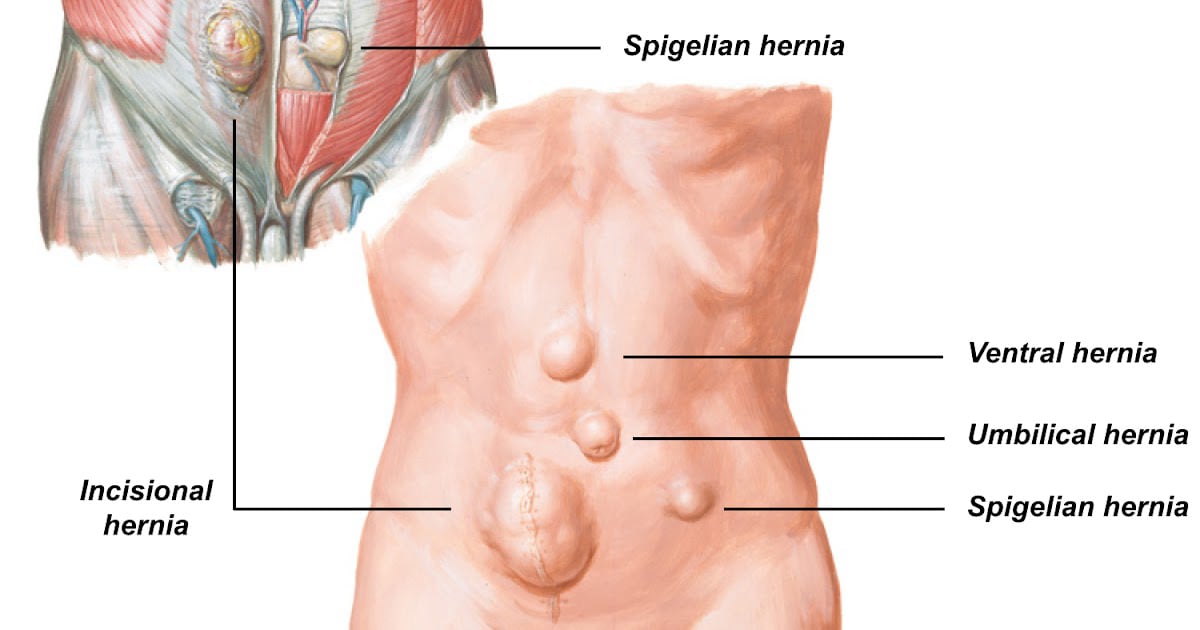 Σπιγγέλειος κήλη