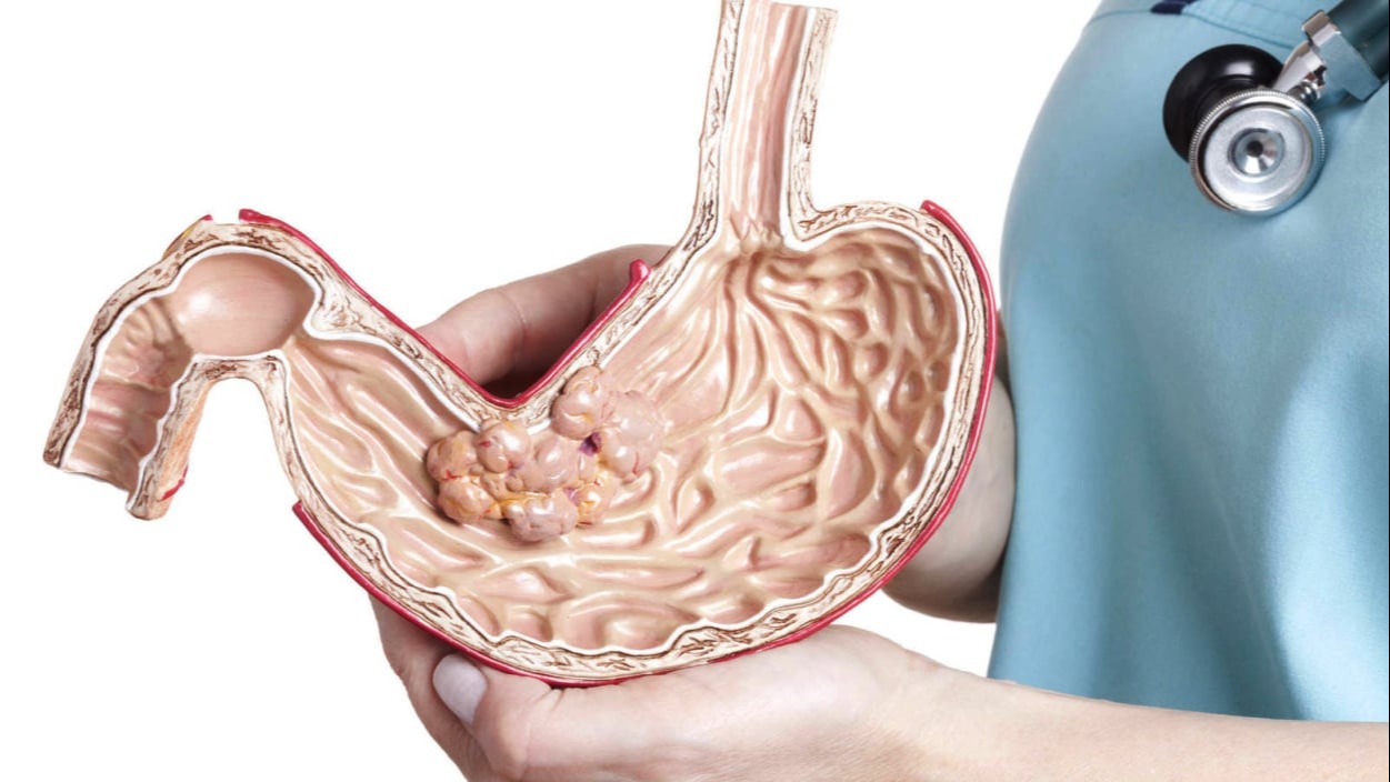 Καρκίνος στομάχου